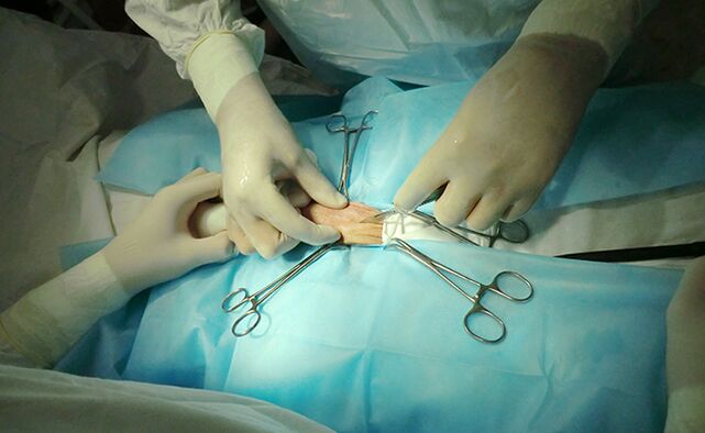 Reproduktiv organdagi jarrohlik uning hajmini oshirishga yordam beradi