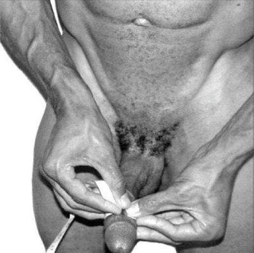 Kengayishdan oldin jinsiy olatni o'lchash